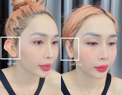 Top 10+ địa chỉ tiêm Filler uy tín tại TP. Thủ Đức