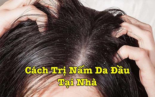 Cách Trị Nấm Da Đầu Tại Nhà